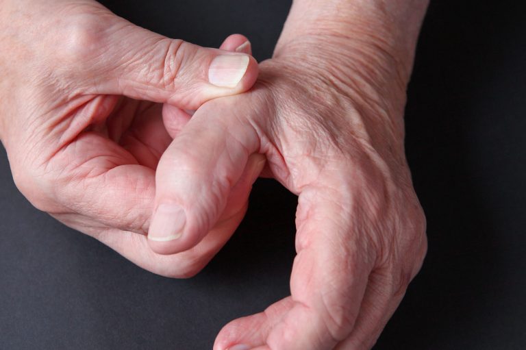 Action Rehab Hand Therapy Clinic | Thumb Arthritis - Carpometacarpal Osteoarthritis