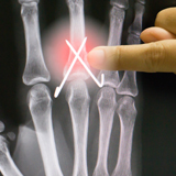 Mallet Finger | Action Rehab Hand Therapy Clinic - Shoulder, Elbow, Wrist and Hand Physiotherapists
