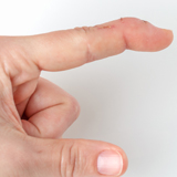 Mallet Finger | Action Rehab Hand Therapy Clinic - Shoulder, Elbow, Wrist and Hand Physiotherapists