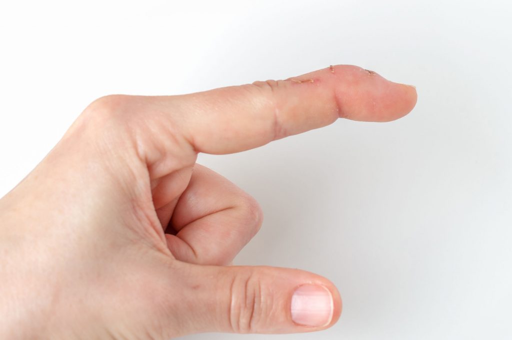 Action Rehab Hand Therapy Clinic - Mallet-finger