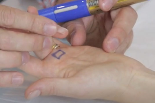 Trigger Finger and Pregnancy | Action Rehab Hand Therapy Clinic