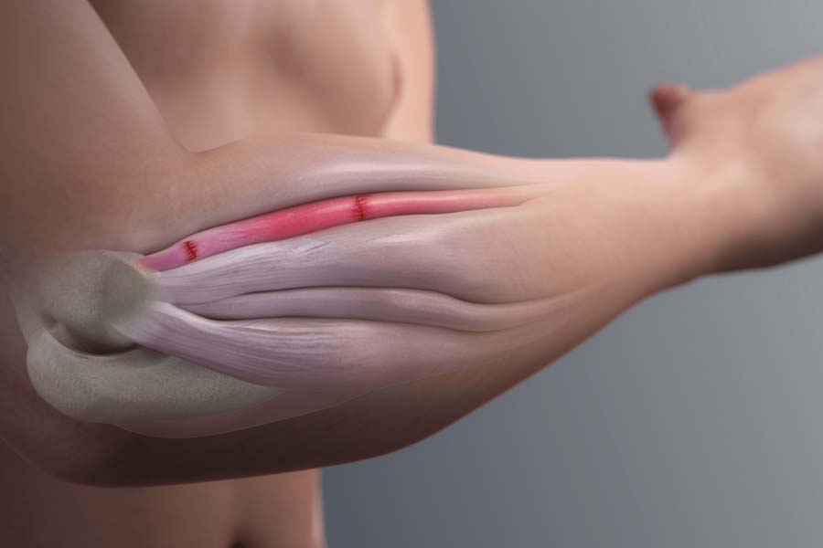 Tennis Elbow Treatment Melbourne