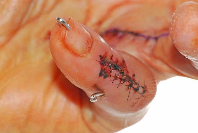 Tendon Injury - Central Slip Injury