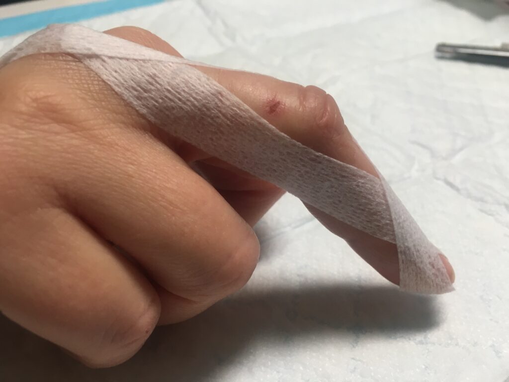 Central Slip Injury Treatment Melbourne