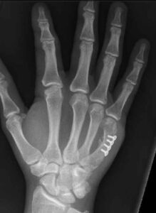 Metacarpal Fracture Xray | Action Rehab Hand Therapy Clinic