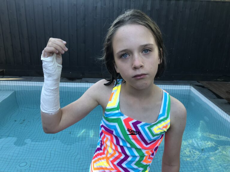 Pop Casts for Fractures | Action Rehab Hand Therapy Clinic