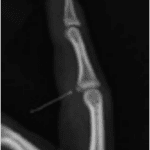 Finger Dislocation Volar Plate Xray