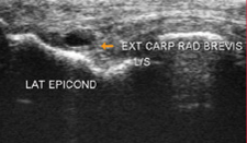Tennis Elbow Xray | Action Rehab Hand Therapy Clinic
