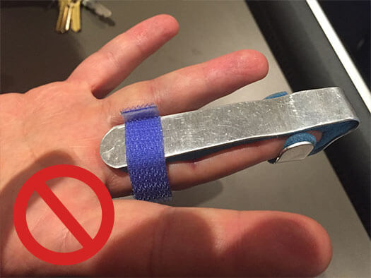 Trigger Finger Incorrect Treatment