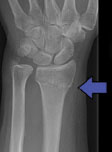 Distal-Radius-Fracture-Imaging