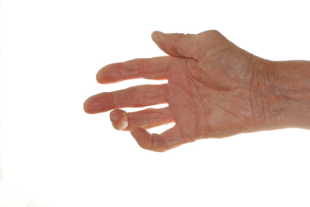 Hand Arthritis - Hand Therapy Treatment Melbourne | Action Rehab Hand Therapy Clinic