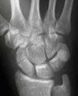 Scaphoid Fracture Imaging
