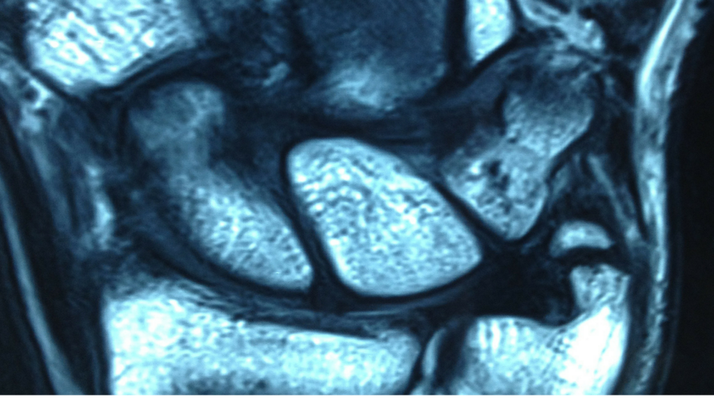 Hand Injury Xray | Action Rehab Hand Therapy Clinic