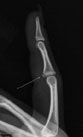 Volar Plate Avulsion Fracture