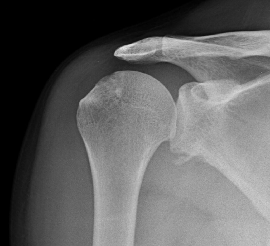 Shoulder Dislocation - Poster or Anterior Fracture