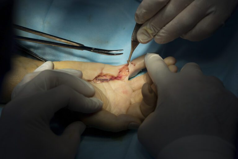 Hand Surgery Melbourne | Action Rehab Hand Therapy Clinic