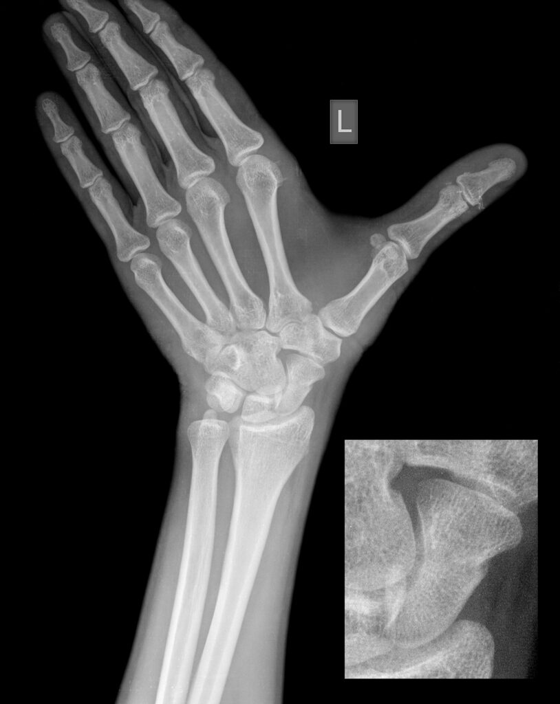 Scaphoid Fracture Xray | Action Rehab Hand Therapy Clinic