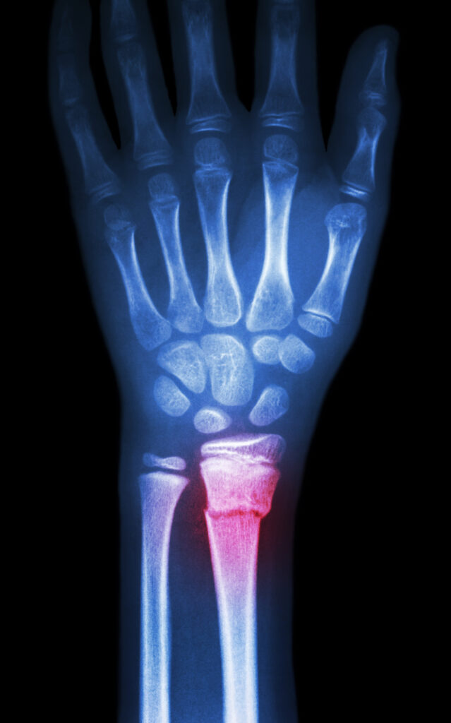 Greenstick Fracture or Paediatric Fracture Treatment