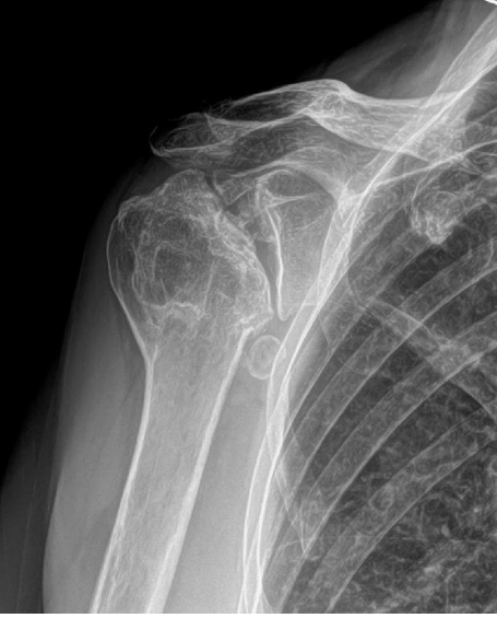 Shoulder Replacement - Advanced OA | Action Rehab Hand Therapy Clinic