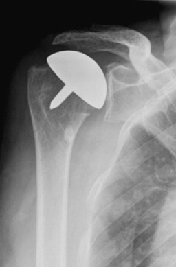 Shoulder Replacement Brisbane | Action Rehab Hand Therapy Clinic