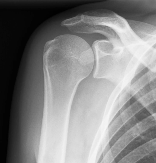 Shoulder Replacement - Normal | Action Rehab Hand Therapy Clinic