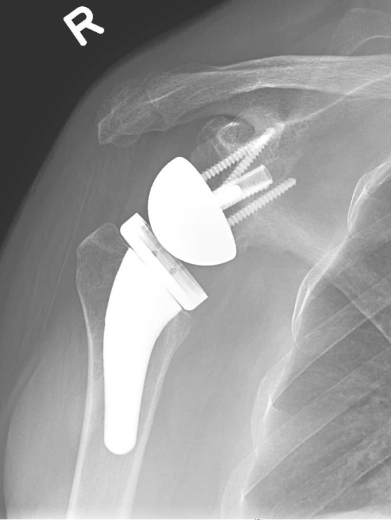 Reverse Shoulder Replacement Brisbane | Action Rehab Hand Therapy Clinic