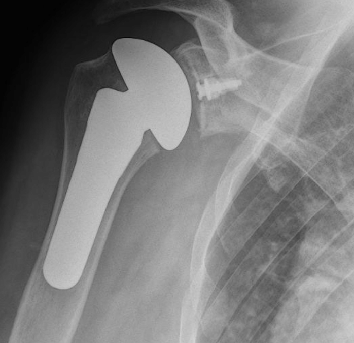 Total Shoulder Replacement Brisbane | Action Rehab Hand Therapy Clinic