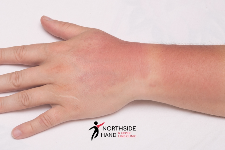 Enjoy a Day at the Beach without Hand Injuries | Northside Hand and Upper Limb Clinic