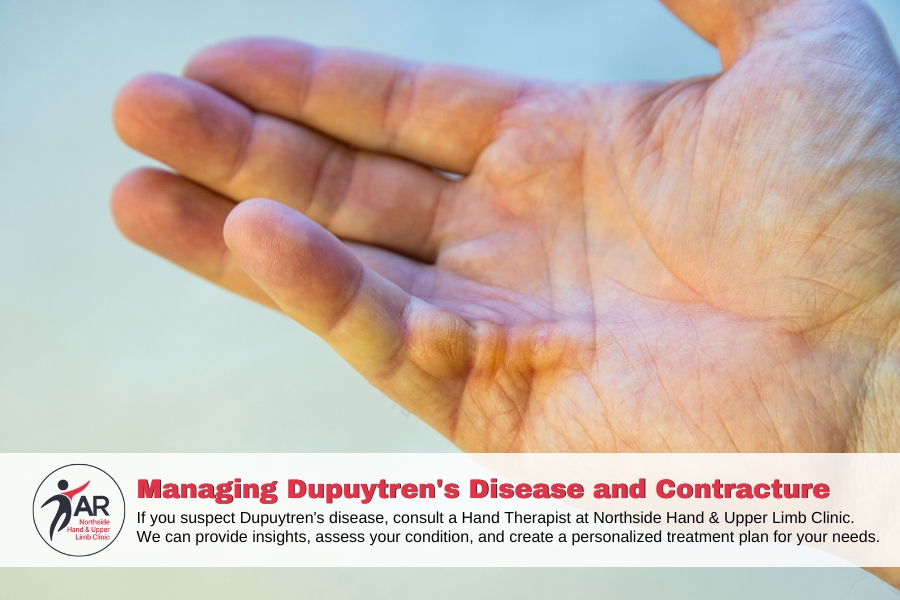 Dupuytren’s Disease and Contracture: A Deep Dive into Causes and Effects | Action Rehab Hand Therapy Clinic - Shoulder, Elbow, Wrist and Hand Physiotherapists Dupuytren’s Disease and Contracture: A Deep Dive into Causes and Effects | Action Rehab Northside Hand and Upper Limb Clinic