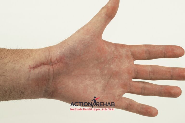 Journal | Action Rehab Hand Therapy Clinic - Shoulder, Elbow, Wrist and Hand Physiotherapists Healing and Beyond Advanced Techniques in Scar Management | Action Rehab Northside Hand & Upper Limb Clinic