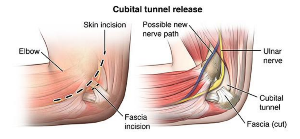 Cubtial Tunnel Syndrome & The Ulnar Nerve | Action Rehab Hand Therapy Clinic - Shoulder, Elbow, Wrist and Hand Physiotherapists