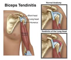 Long Head Bicep Tendinopathy | Action Rehab Hand Therapy Clinic - Shoulder, Elbow, Wrist and Hand Physiotherapists