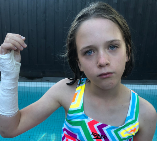 Child with forearm cast by pool during fracture recovery before seeing Action Rehab Northside in Brisbane for suitable, water resistant splint.