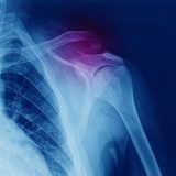 Shoulder Physiotherapy | Action Rehab Hand Therapy Clinic - Shoulder, Elbow, Wrist and Hand Physiotherapists Acromioclavicular (AC) Joint Injury | Action Rehab Hand Therapy Clinic