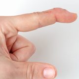 Mallet Finger Treatment | Action Rehab Hand Therapy Clinic